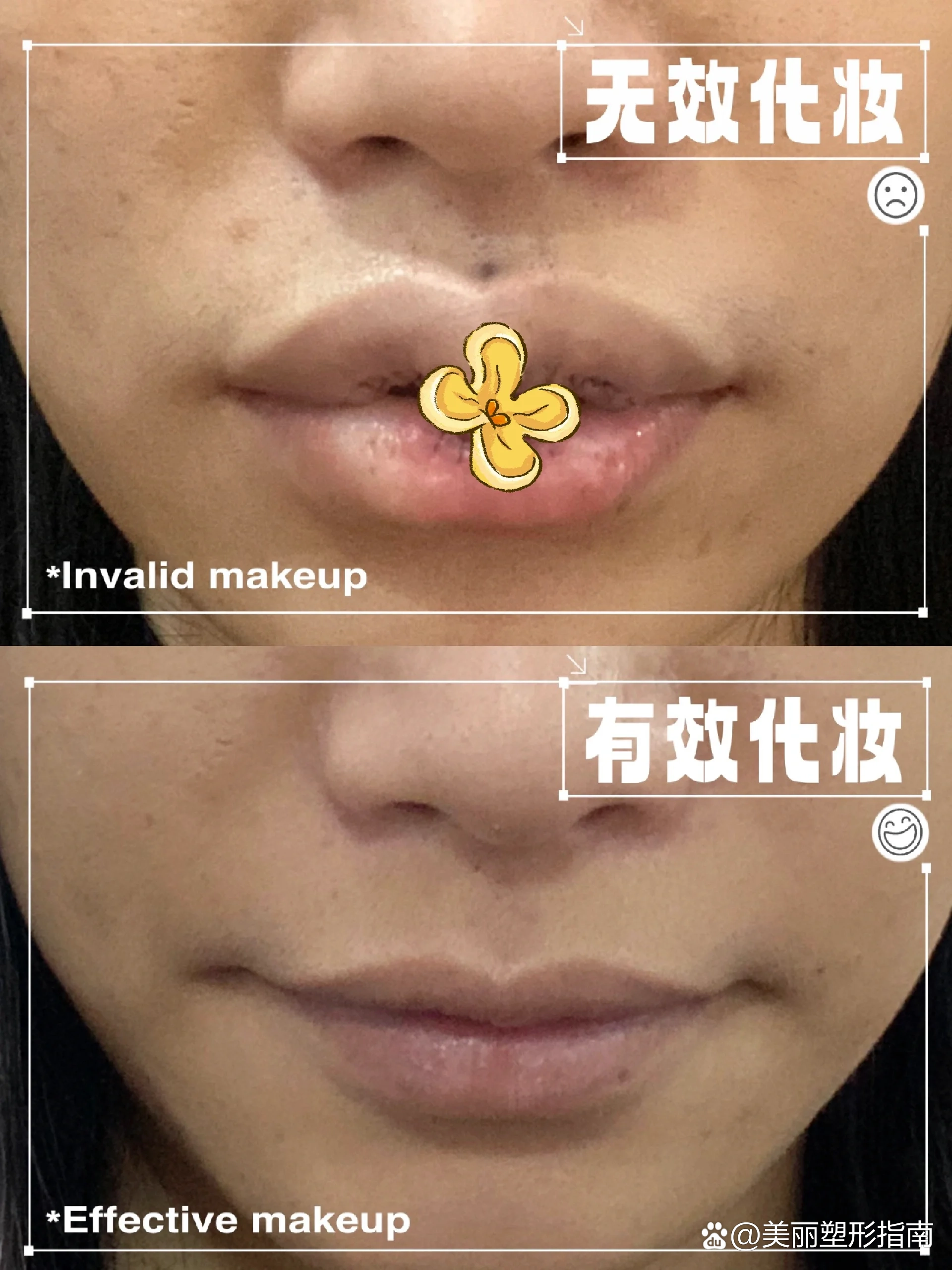 嘴唇厚如何变薄_(嘴唇厚如何变薄的视频)