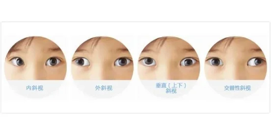 交替性斜视-(交替性斜视怎么矫正)