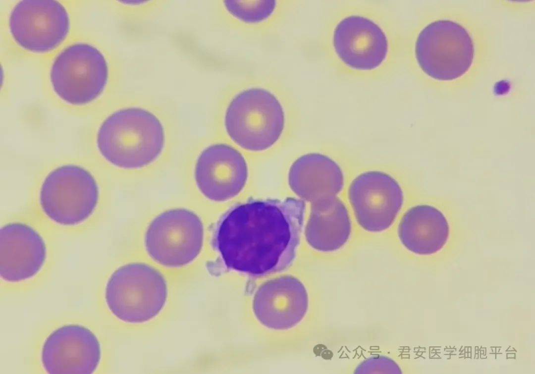异形细胞-(异形细胞一般10个癌)
