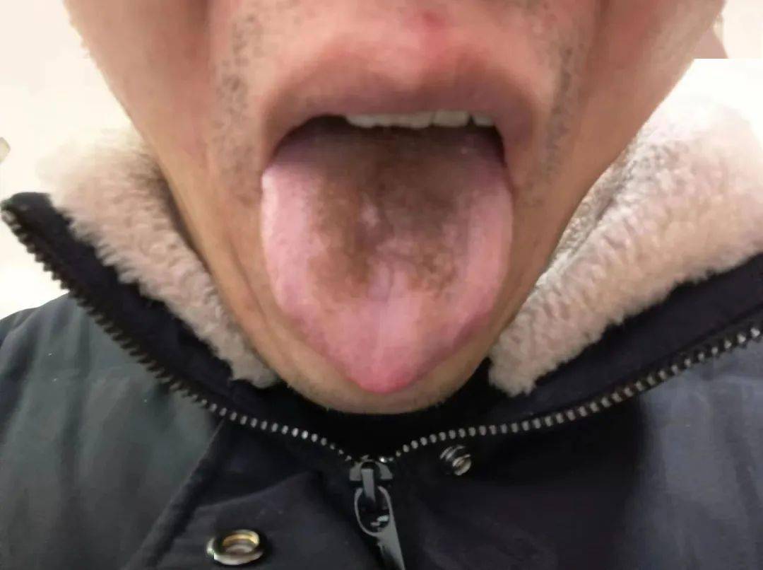 舌头发黑_(舌头发黑怎么回事哪里出现问题了)