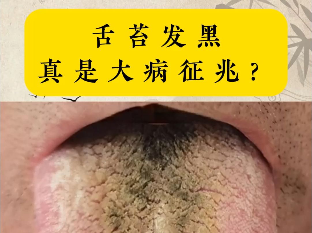 舌头发黑_(舌头发黑怎么回事哪里出现问题了)