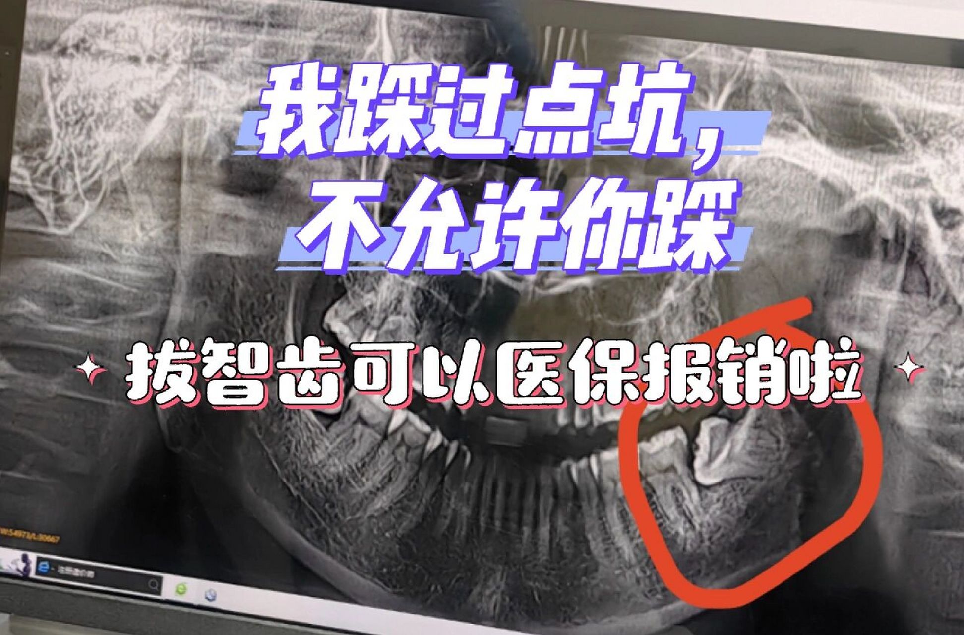 拔智齿可以报销吗(拔智齿一颗牙多少钱可以用医保吗)