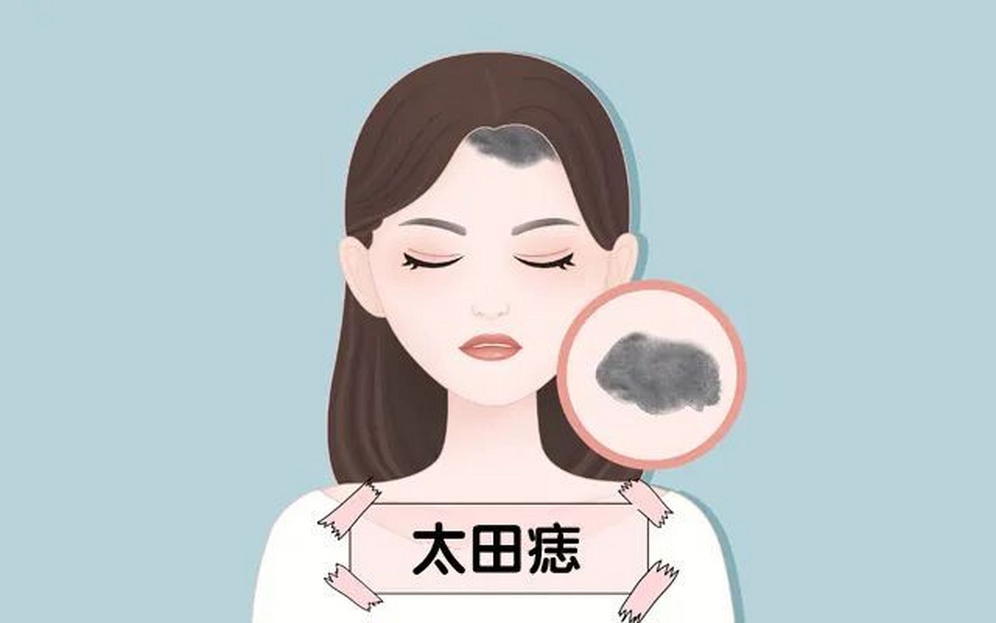 太田痣怎么去除_(太田痣到底能不能彻底去除)