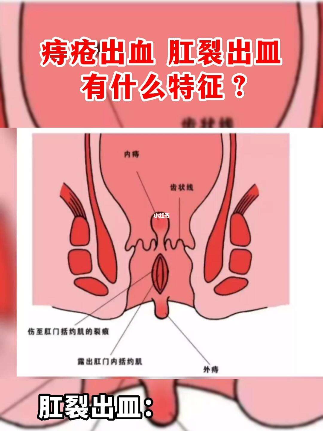 肛门流血_(肛门流血可以涂红霉素吗)