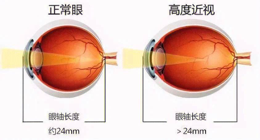 生理性远视-(几岁前呈生理性远视)