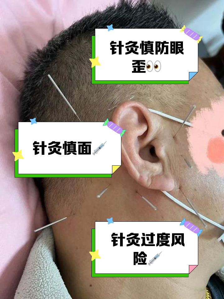 面部针灸-(面部针灸图片)