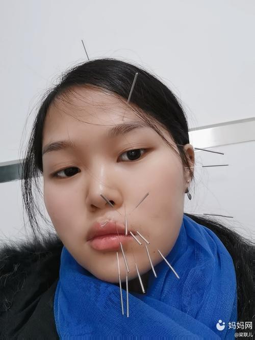 面部针灸-(面部针灸图片)