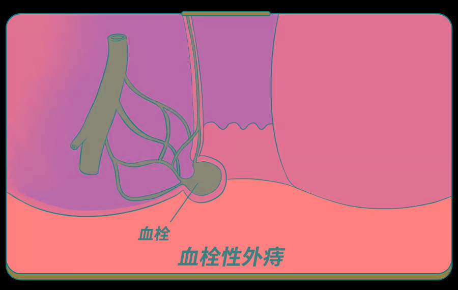 血栓性外痔-(血栓性外痔多久能消肿,能变小到啥程度)