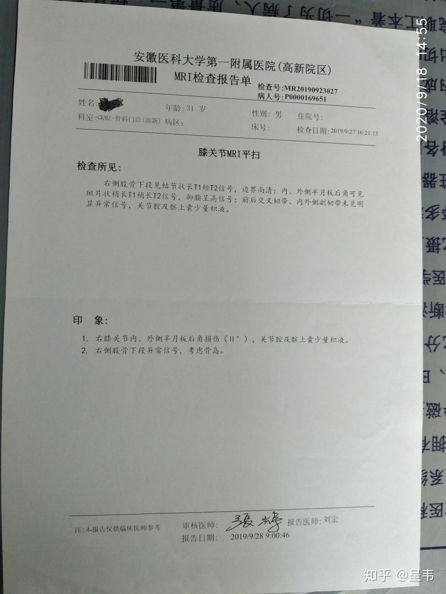 半月板二度损伤_(半月板二度损伤严重吗)