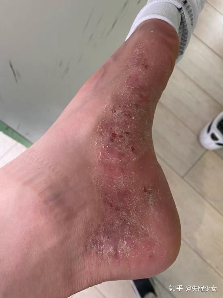 糜烂型脚气-(糜烂型脚气怎么治才能除根)
