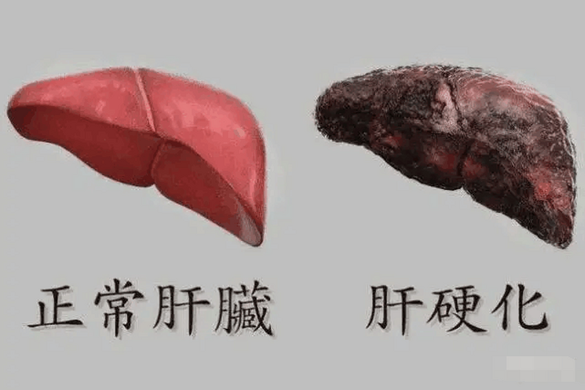 肝硬化能逆转吗_(骨髓治肝硬化能逆转吗)