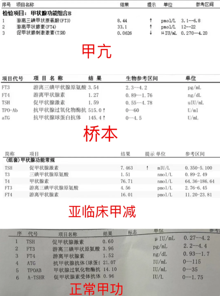 甲减化验单怎么看-(甲减主要看哪一项指标)