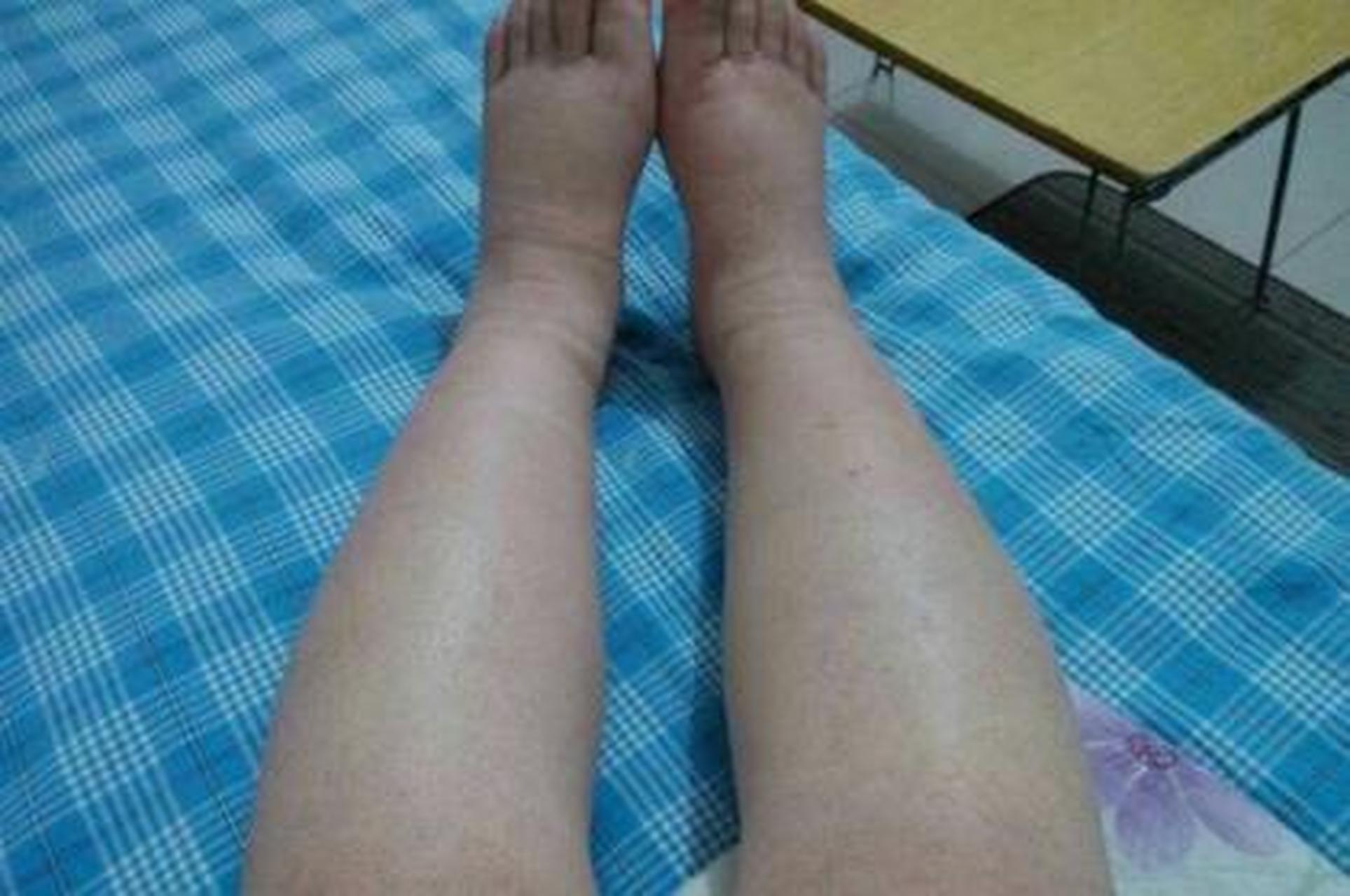 血糖高腿肿怎么办-(糖尿病人腿肿危险吗)