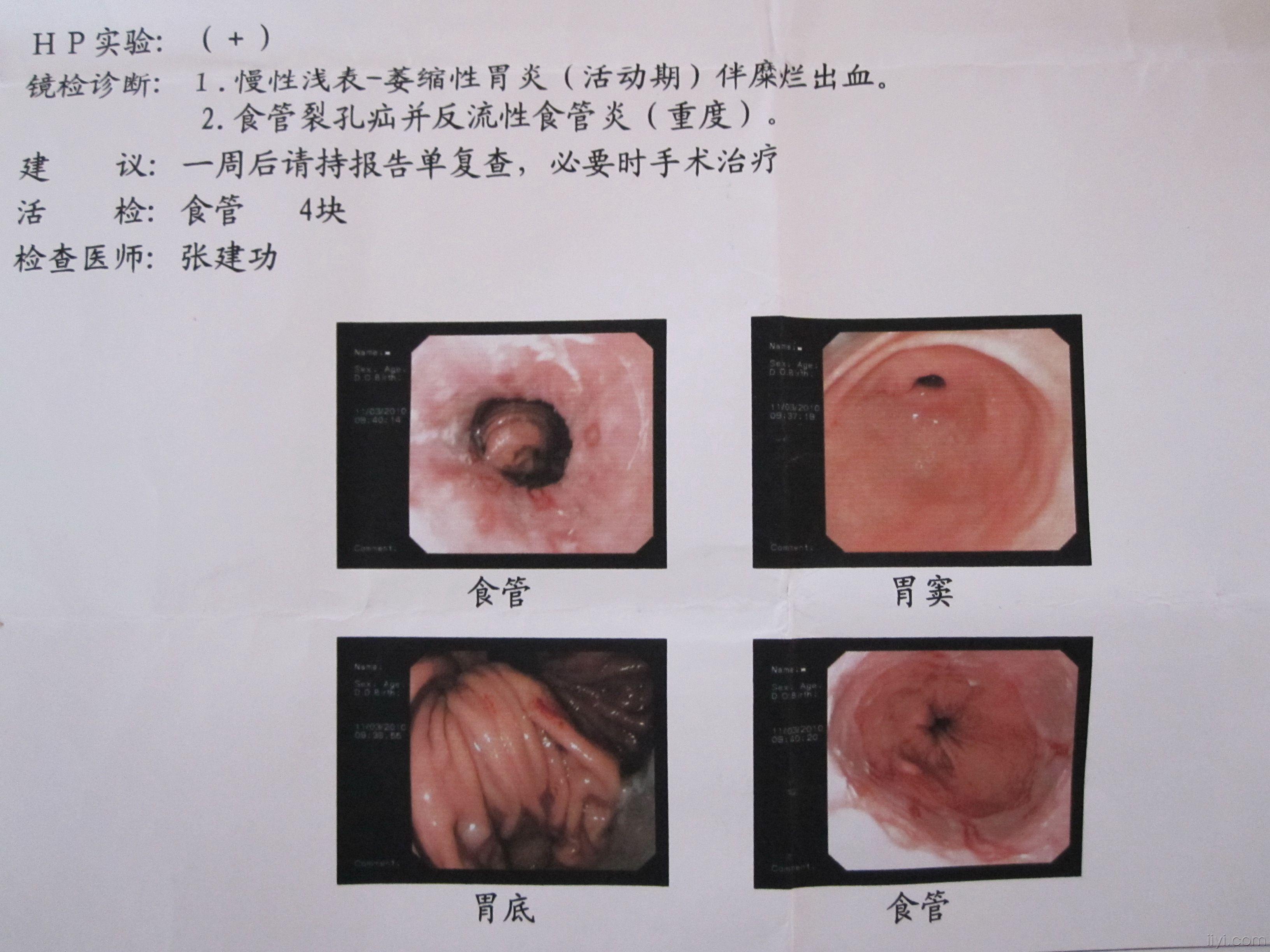 反流性食管炎A级(反流性食管炎a级需要治疗吗)