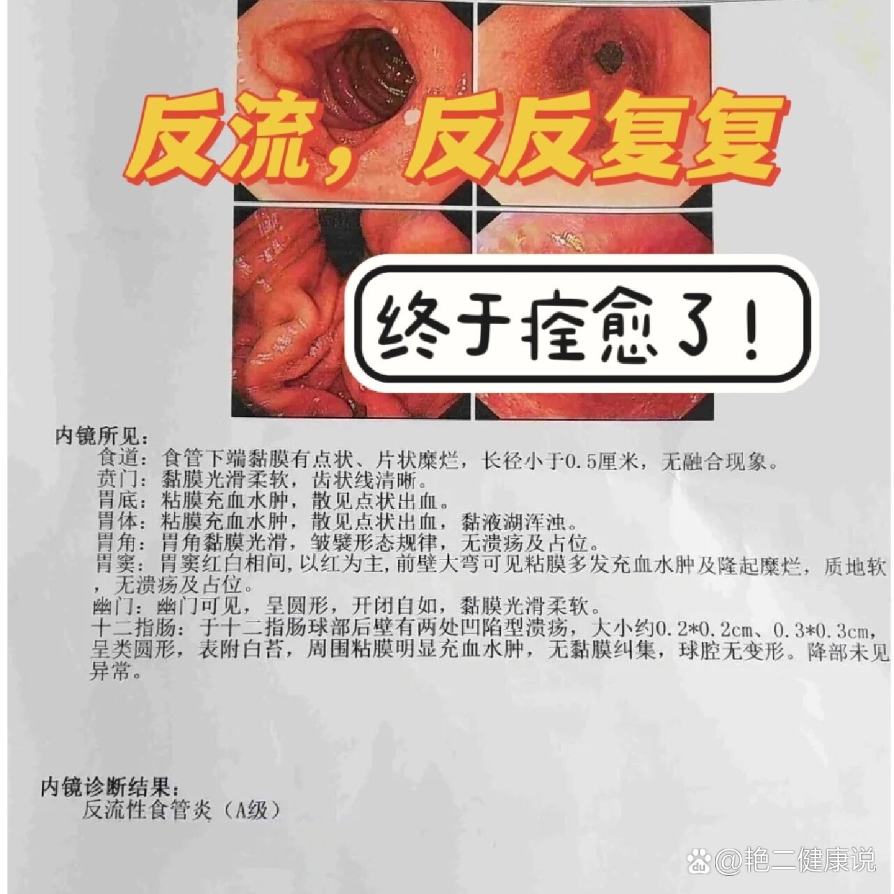 反流性食管炎A级(反流性食管炎a级需要治疗吗)