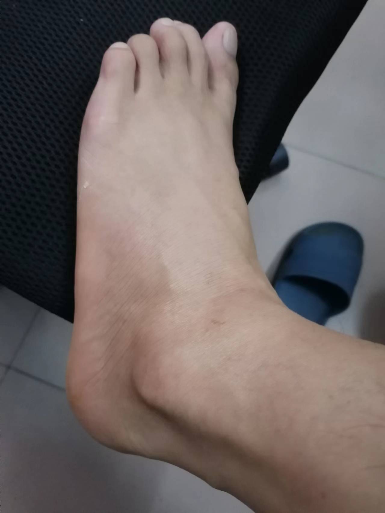 脚扭伤_(脚扭伤肿怎么消肿最好最快)