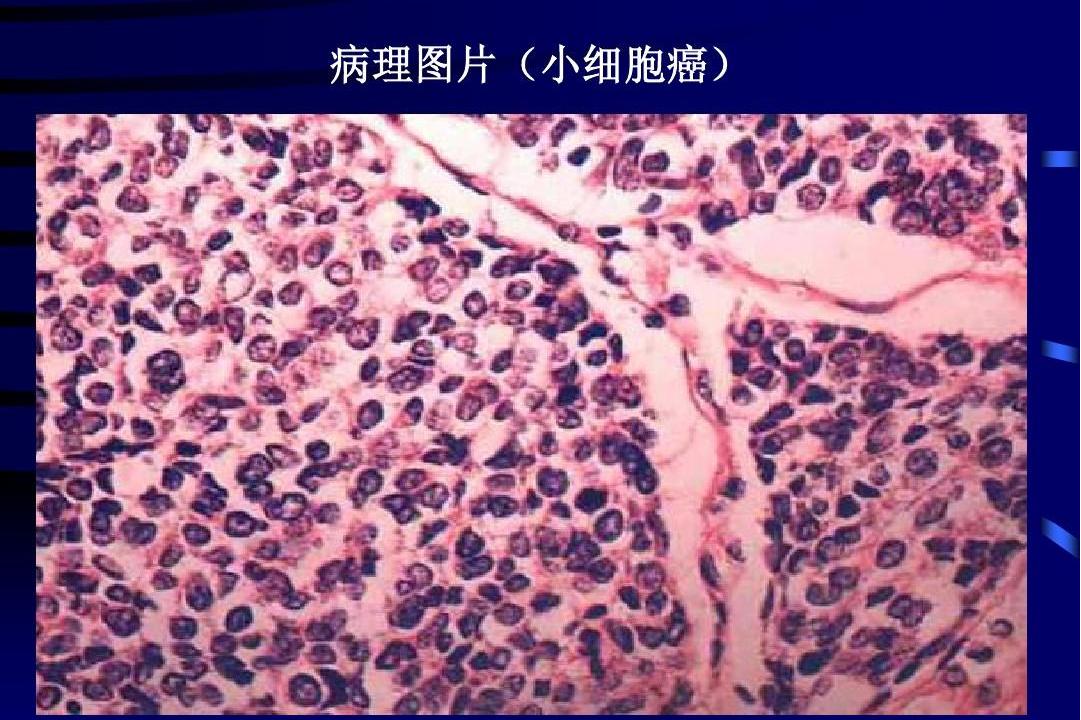 小叶原位癌-(小叶原位癌需要化疗吗)