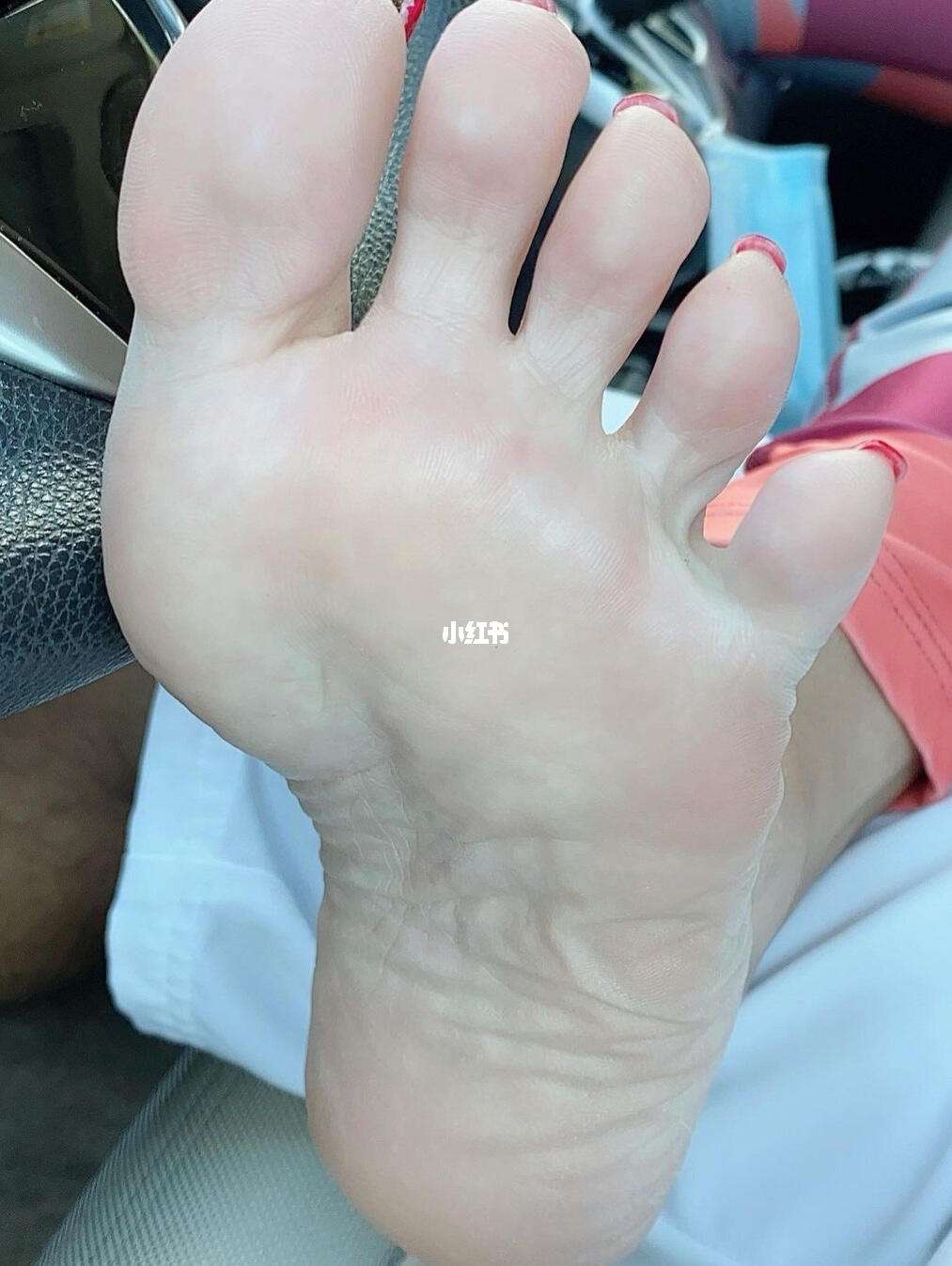 脚丫子脱皮(小朋友脚丫子脱皮)