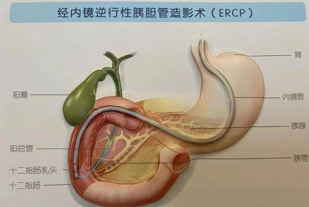 胆结石多大要手术(胆结石多大手术治疗必须要切除胆囊吗)