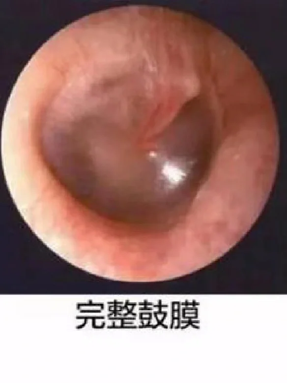 耳膜穿孔什么症状(耳膜穿孔什么症状会自愈吗)