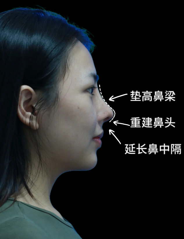垫鼻子有危险吗-(垫鼻子有什么副作用)