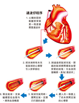 不规则脉波-(不规则脉波3次但血压正常)