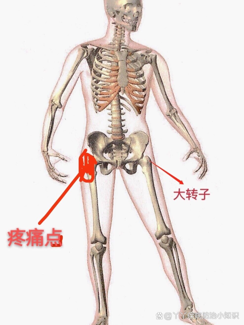 胯骨疼怎么办_(外伤导致胯骨疼怎么办)