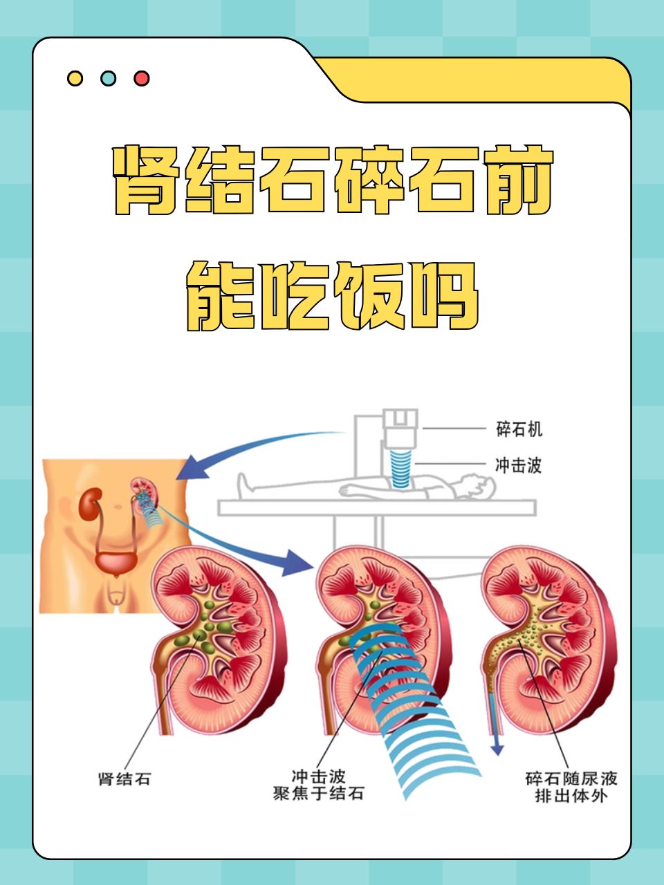 激光碎石疼不疼_(激光碎石十大后遗症)