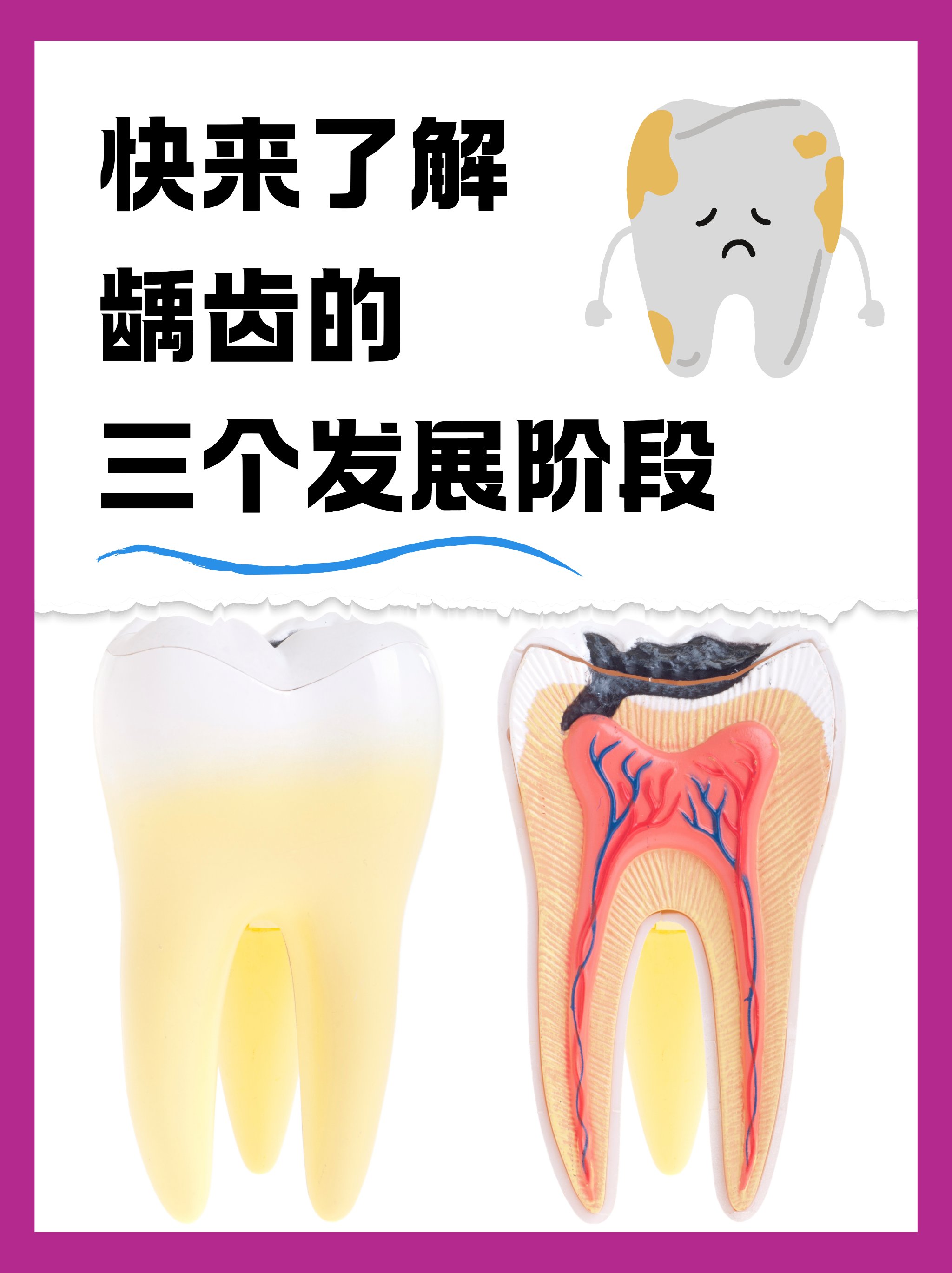 龋齿牙疼怎么办_(龋齿牙疼怎么办可以拔掉吗)