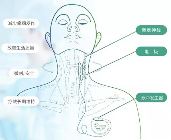 婴儿痉挛症的症状(婴儿痉挛症的症状图片宝宝突然抖了两下)