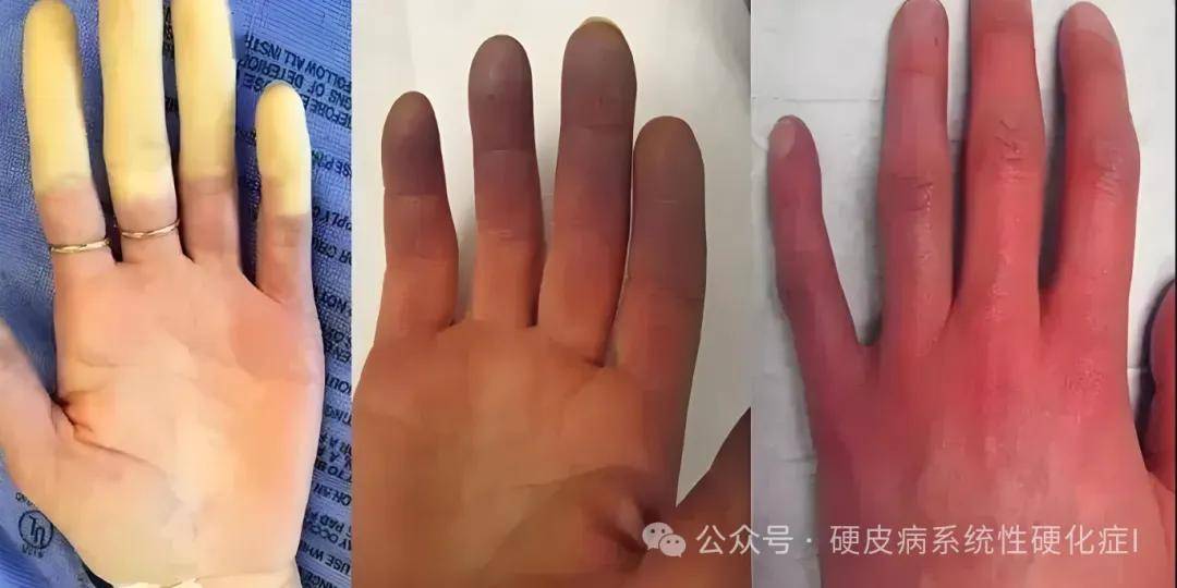 硬皮症早期症状_(硬皮症早期症状图片)