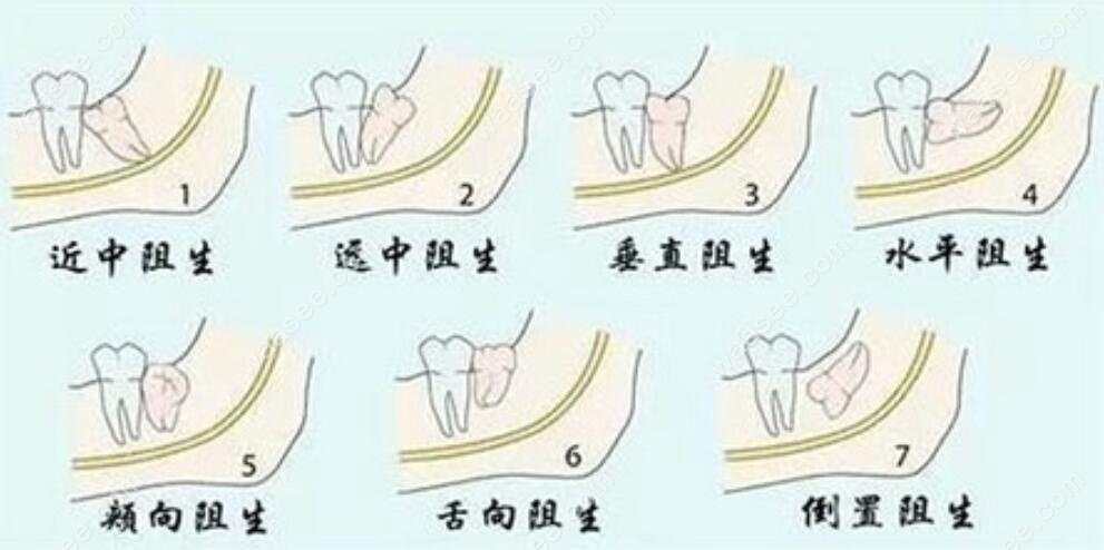 孕妇能拔牙齿吗-(孕妇能不能拔牙)