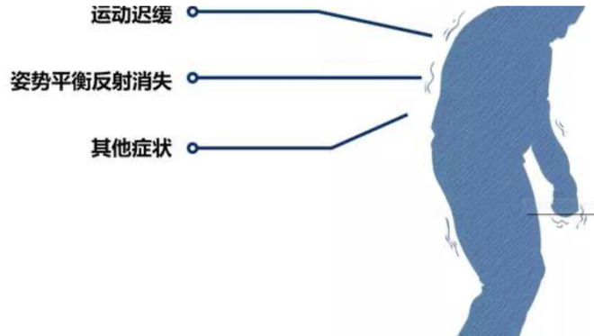 震颤是什么意思-(眼球震颤是什么意思)