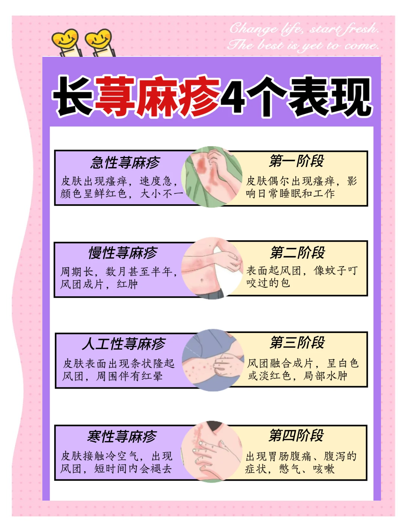荨麻疹种类(荨麻疹种类辨别图片)