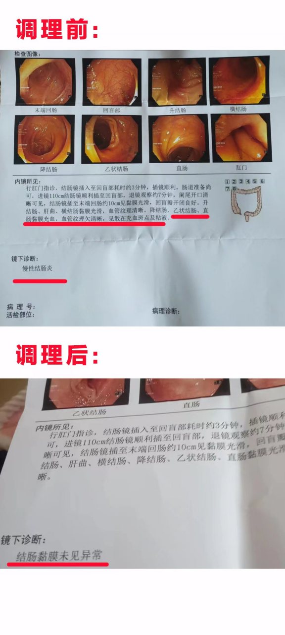 做肠镜难受吗(儿童不能喝泻药,灌肠做肠镜难受吗)
