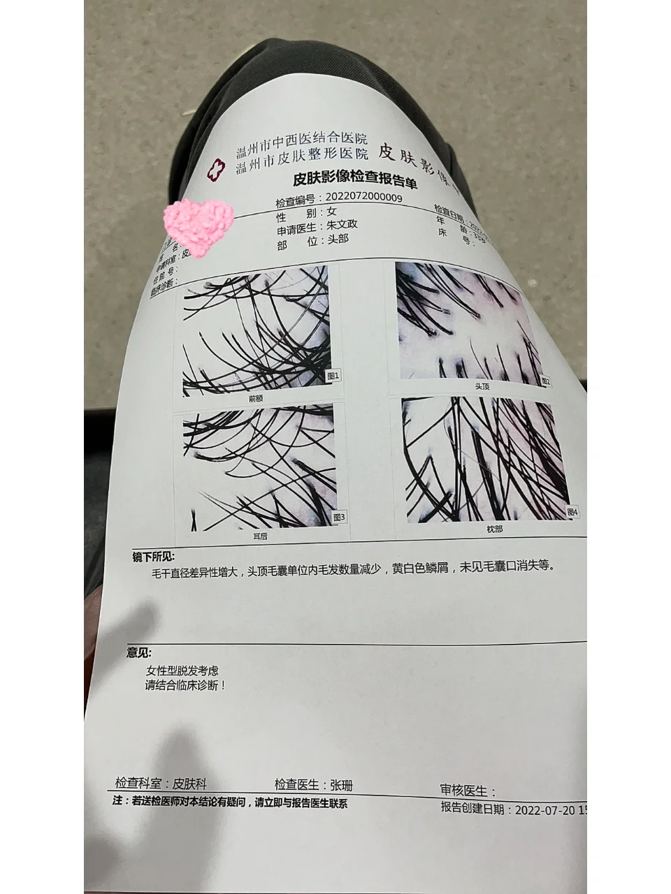 脱发检查哪些项目-(脱发 检查)