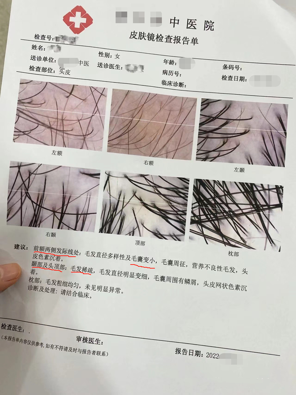 脱发检查哪些项目-(脱发 检查)