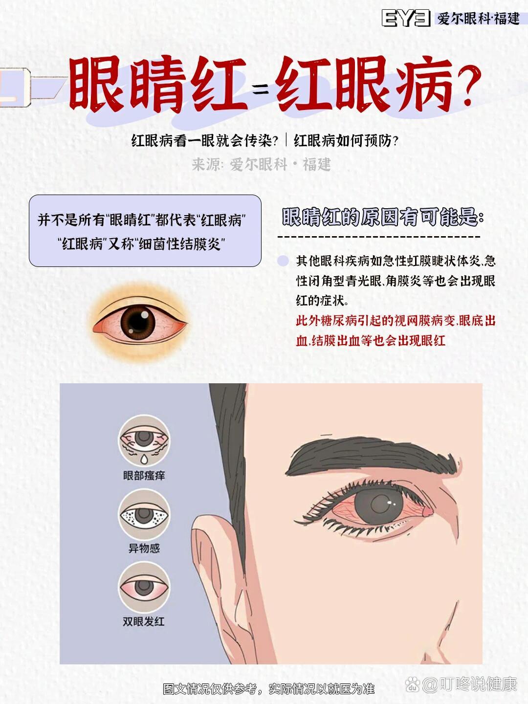 眼睛发红的原因_(眼睛发红的原因被导致)