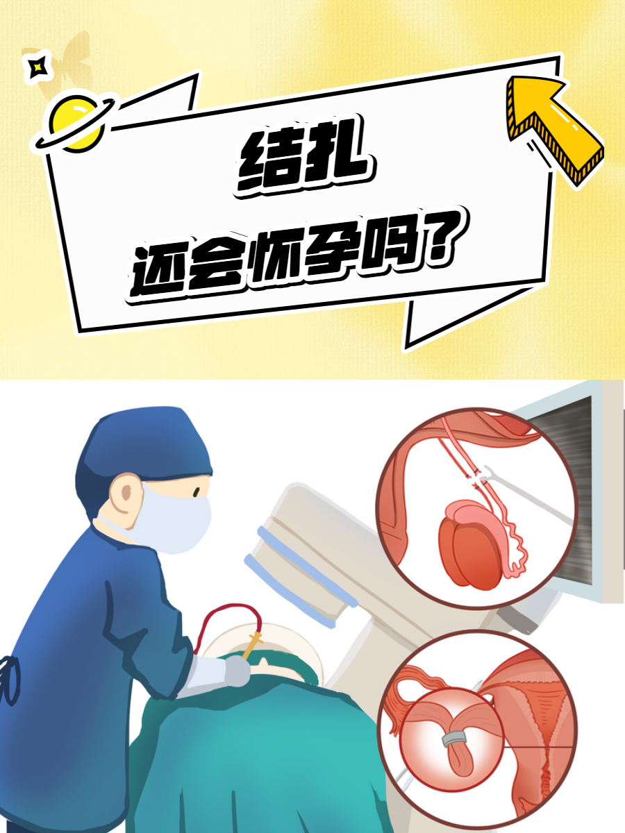 结扎后会怀孕吗(不孕不育咨询在线咨询留电话)