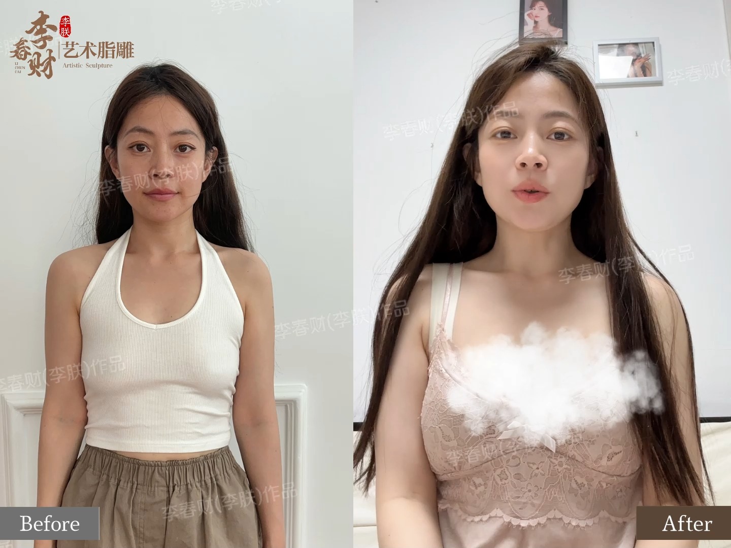 自体脂肪丰胸(自体脂肪丰胸需要做几次)
