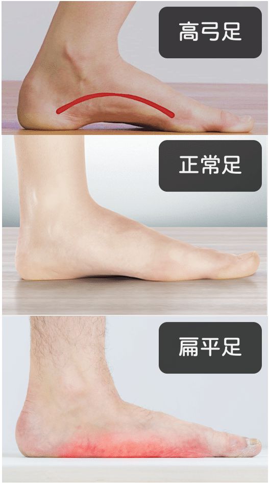 平足可以矫正吗_(扁平足最怕三个运动)