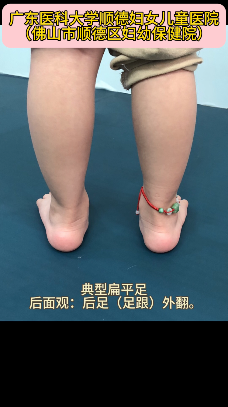 平足可以矫正吗_(扁平足最怕三个运动)