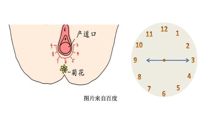 侧切拆线疼不疼-(侧切拆线痛吗)