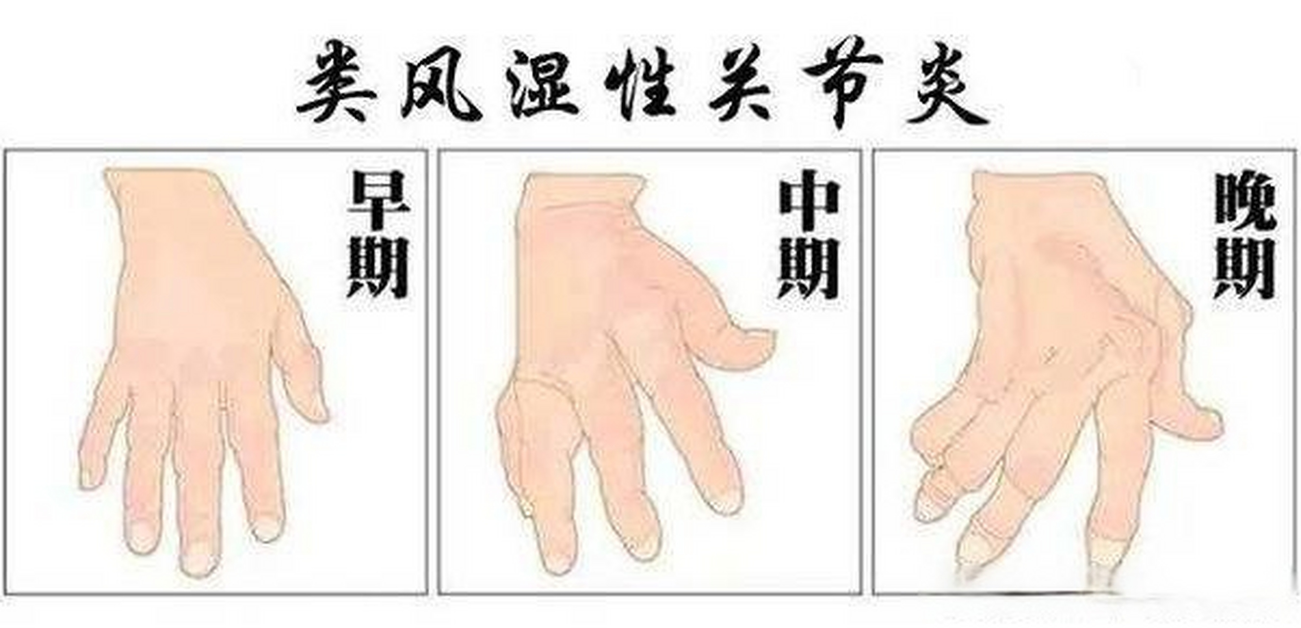 类风湿疼痛(类风湿疼的受不了怎么办)