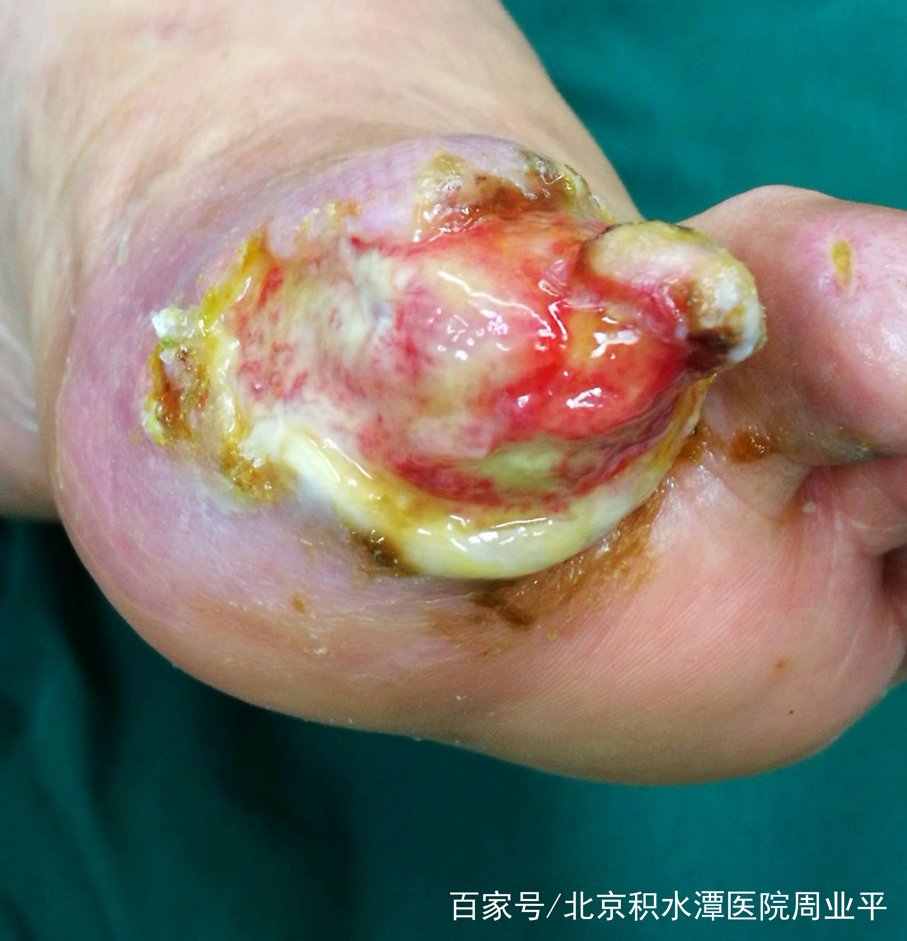 脚趾间溃烂-(脚趾间溃烂脱皮开裂痒用什么药)