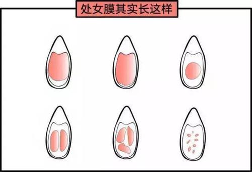 处女膜是白色的吗-(是处和不是处的区别图)