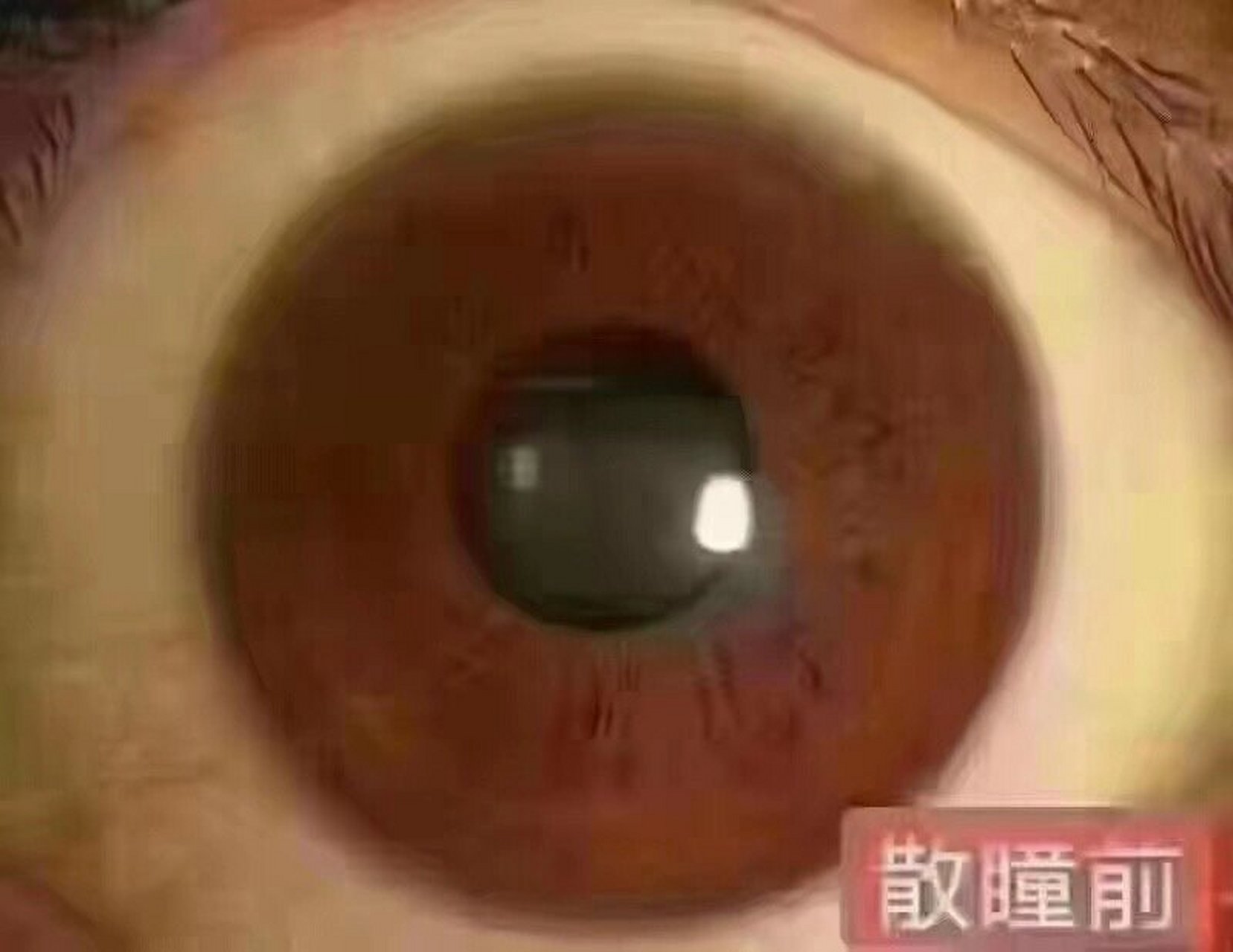 瞳孔散大的原因-(青光眼瞳孔散大的原因)