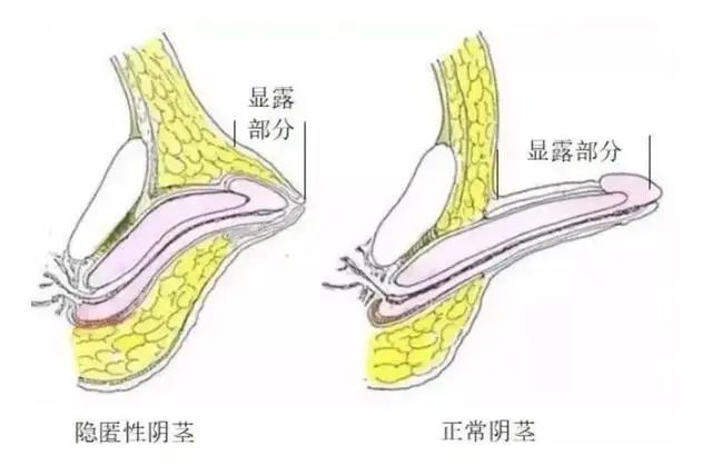 小孩包皮_(小孩包皮图片真实照片)