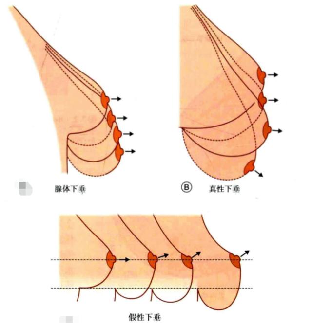 乳房下垂矫正_(乳房下垂矫正手术)