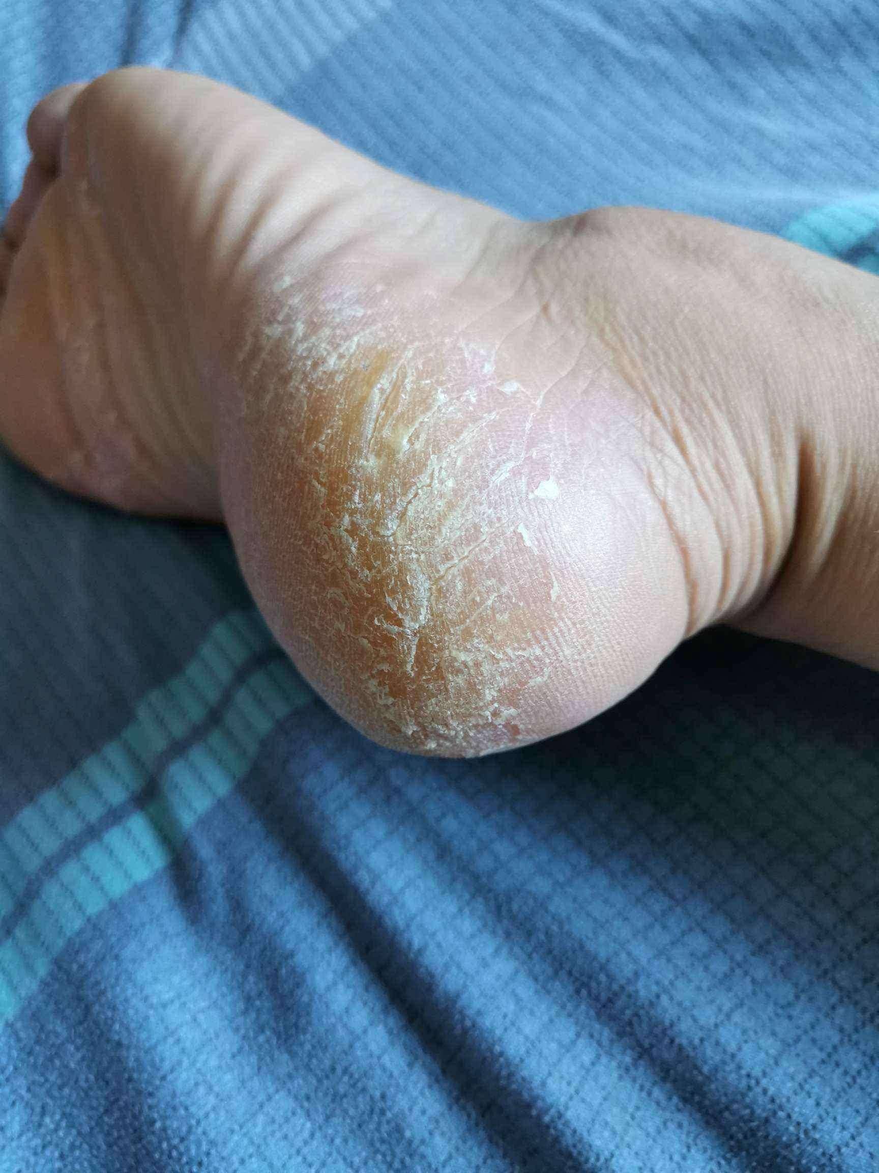 脚后跟疼挂什么科-(早上起来脚后跟疼挂什么科)